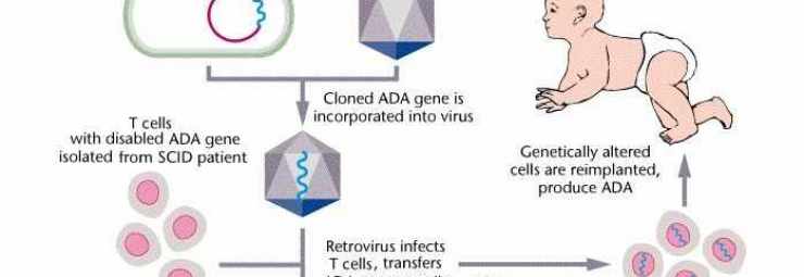 المعالجة الجينية لمتلازمة نقص المناعة الشديد
