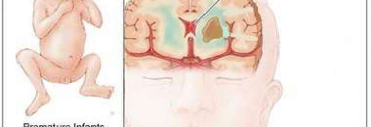 النزيف داخل البطينات الدماغية عند الطفل الخديج