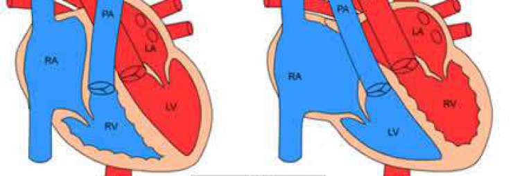 تبادل منشأ الأوعية أو الشرايين الكبيرة في القلب عند الاطفال