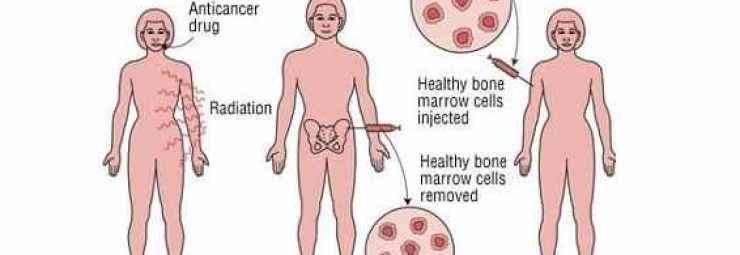 زرع الخلايا الجذعية المولدة للدم