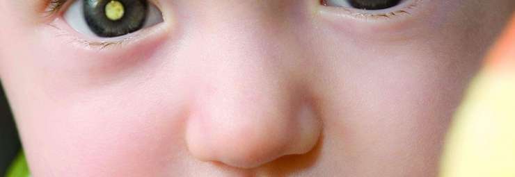 سرطان العين عند الاطفال و الرضع