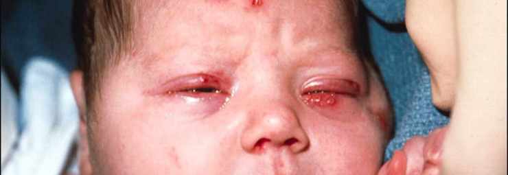 علاج هربس العين عند الطفل حديث الولادة
