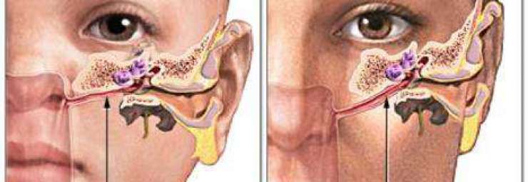 معالجة التهاب الاذن الوسطى